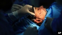 Plastic surgeon Dr. Abbas al-Sahan performs reconstructive surgery on Saja Ahmed Saleem, in Baghdad, Iraq, Nov. 6, 2018. Those whom treatment not available at state-run hospitals and can’t afford treatment at private clinics rely on social media to make an appeal.