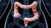 La FDA approuve une thérapie génique contre des cancers lymphatiques agressifs